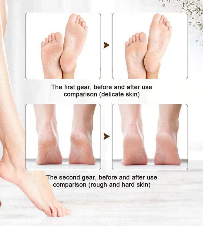 Foot File Callus